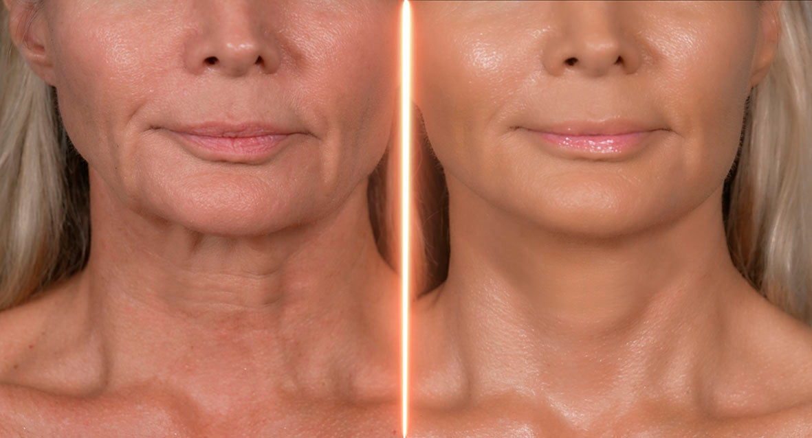 Velform Renew tratamiento facial