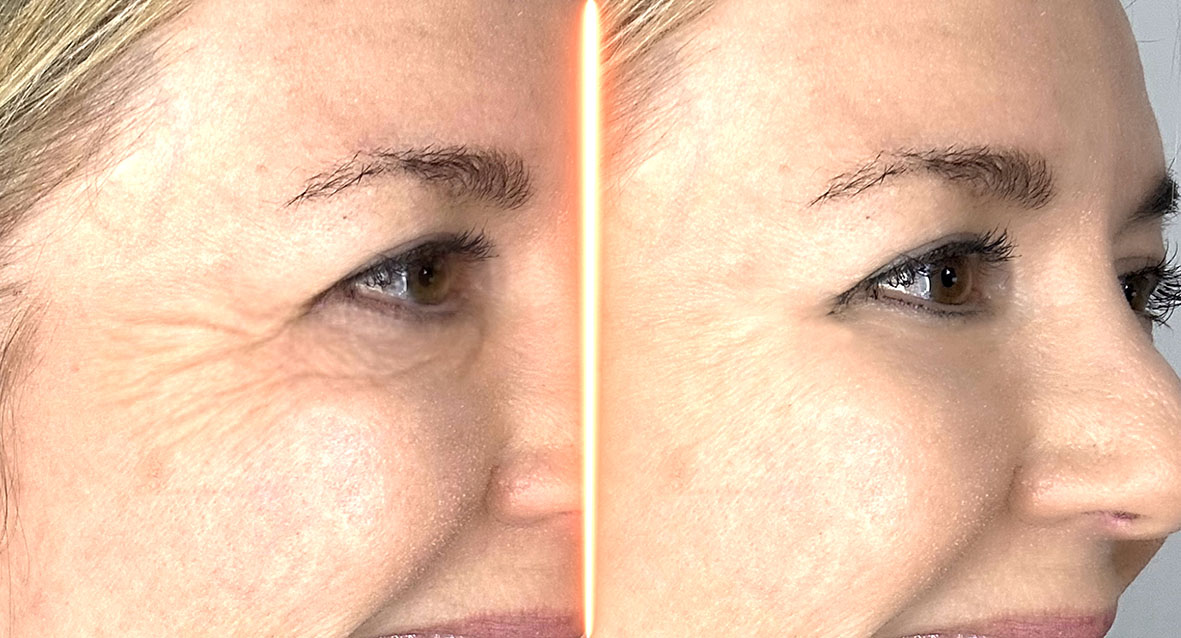 Velform Renew tratamiento facial